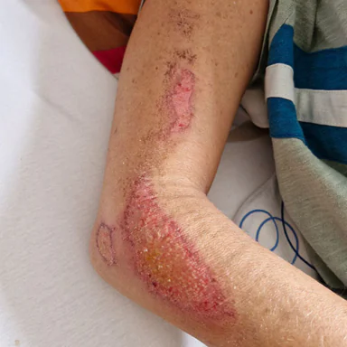 liv_arm_verletzung